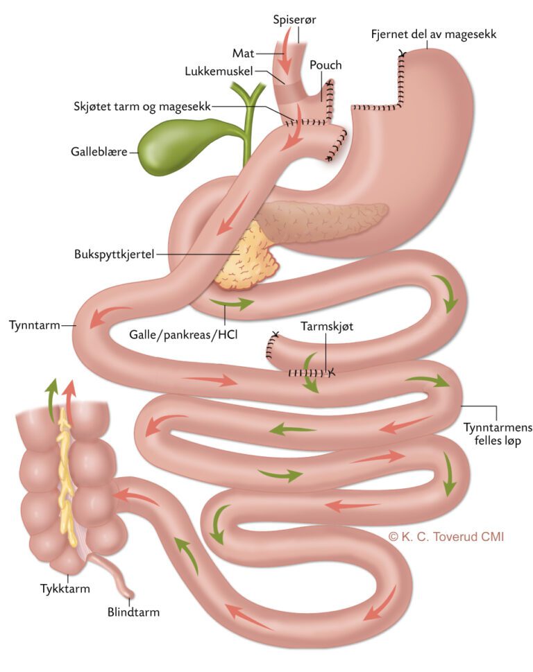 Gastric Bypass illustrasjon slankeoperasjon