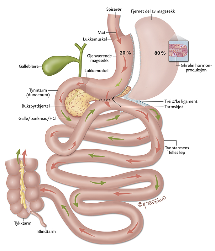 single anastomosis sleeve ileal (sasi) bypass